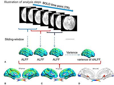 Dynamic Changes of Amplitude of Low-Frequency Fluctuations in Patients With Diabetic Retinopathy